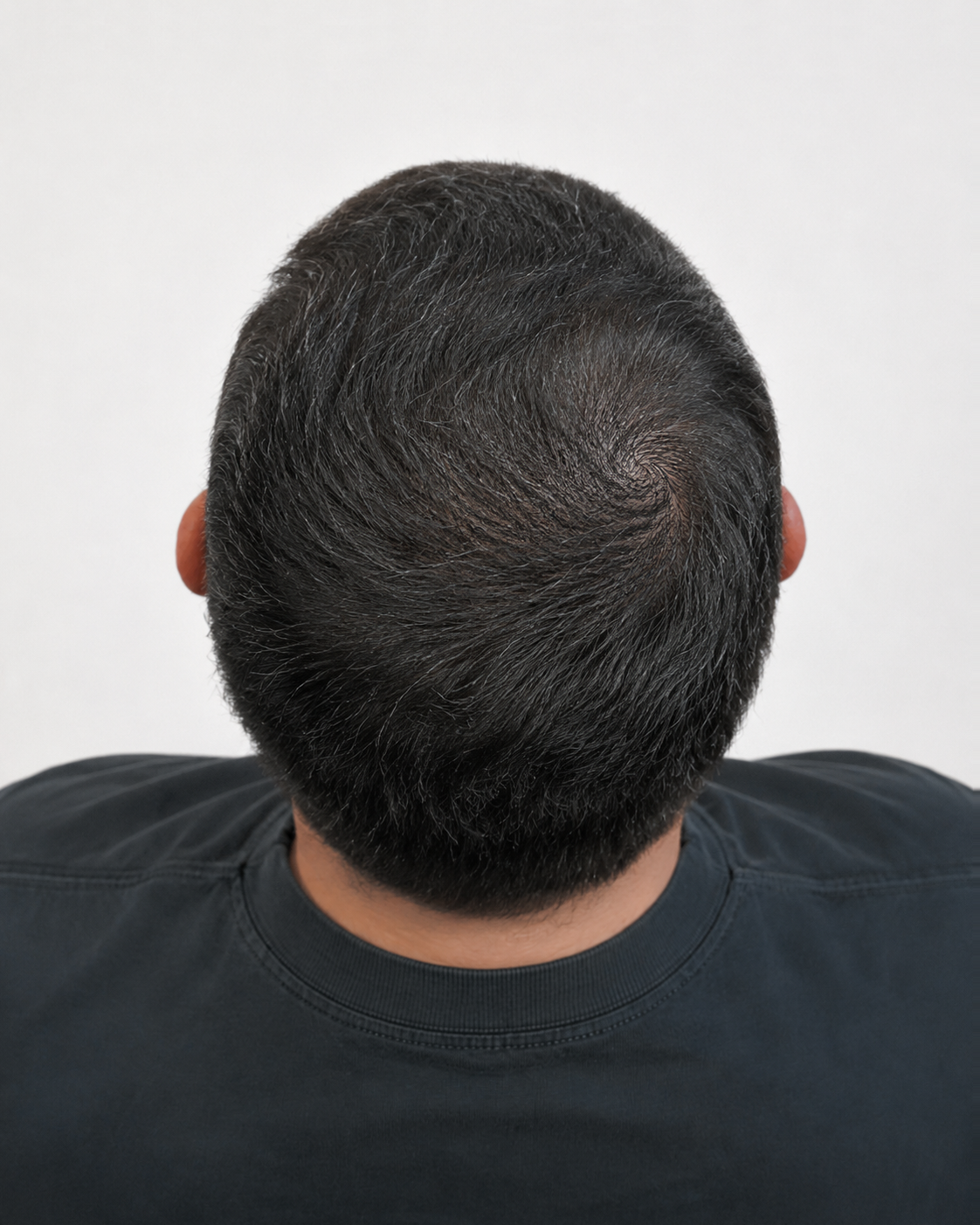 Resultado de Tricopigmentacion capilar: Mayor densidad visual en zona superior